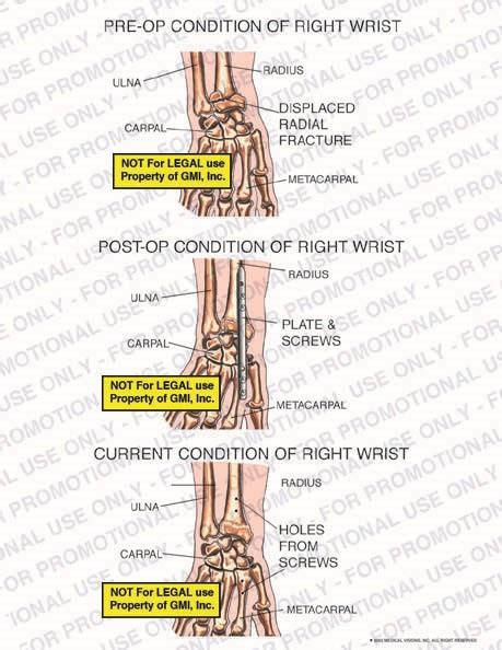 Pre Op Post Op And Current Conditions Of Right Wrist 02448c170a Generic Medical Legal