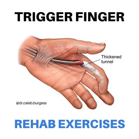 finger tendon injury exercises  carole carr blog
