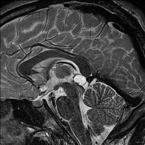 Pineal Cyst Radiology Reference Article