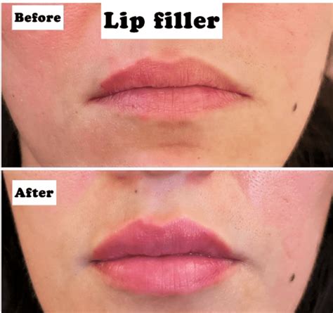 How Long Do Lip Fillers Last A Comprehensive Guide Hiw Pages Dev