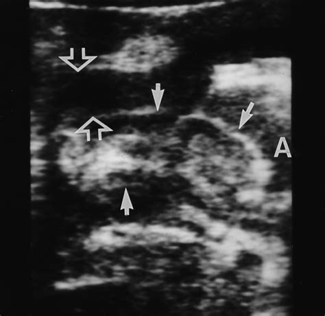 In Vivo Visualization Of Pyloric Mucosal Hypertrophy In Infants With