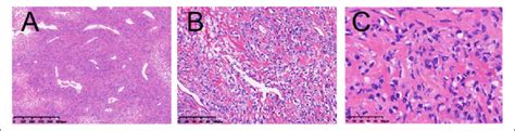 Morphological Findings Of The Solitary Fibrous Tumor Hemangiopericytoma