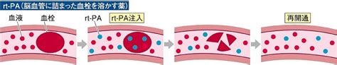 （3）rt―pa静注療法とは 川崎医科大学 脳卒中医学教室講師 祢津智久｜岡山の医療健康ガイド Medica