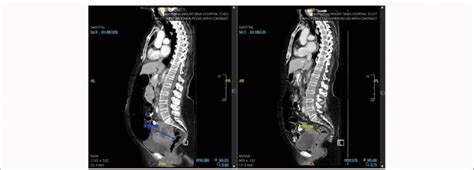 CT Chest Abdomen And Pelvis Sagittal View Before After Treatment