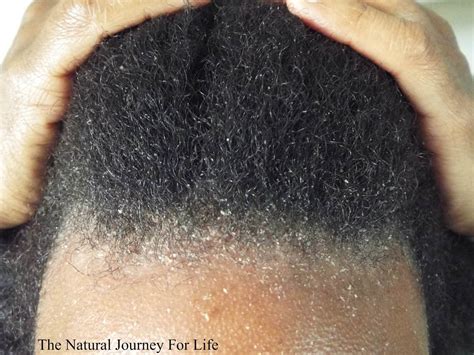 White Balls in Hair: Is It Dandruff or Something Else? - Hunter Games Magazine