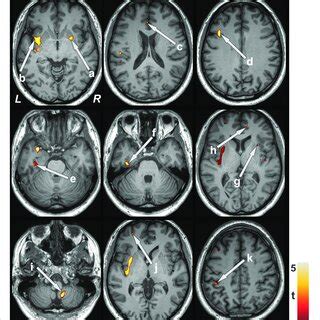 Brain Regions With Decreased Gray Matter Volume After Lung Transplant