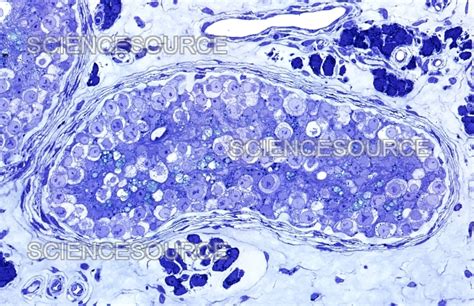 Human Testis Cancer Light Micrograph Stock Image Science Source Images