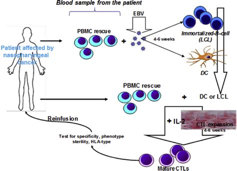 CTL Based Nasopharyngeal Adoptive Therapy Reinfusion Of EBV Antigens