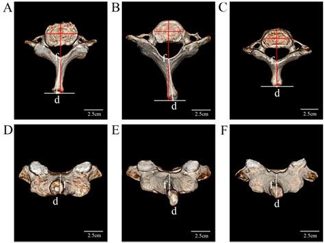 An Anatomical Study Of The Spinous Process Of The Seventh Cervical