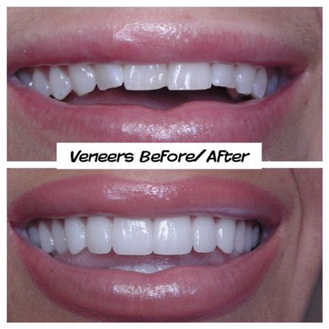 Porcelain Veneers By San Diego Cosmetic Dentist Dr Eshom Veneers