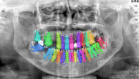 使用实例分割和标记在x射线图像中识别牙齿（pytorch代码） Csdn博客