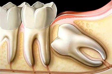 Cirurgia Extração de Siso Iorc Clínica Odontológica