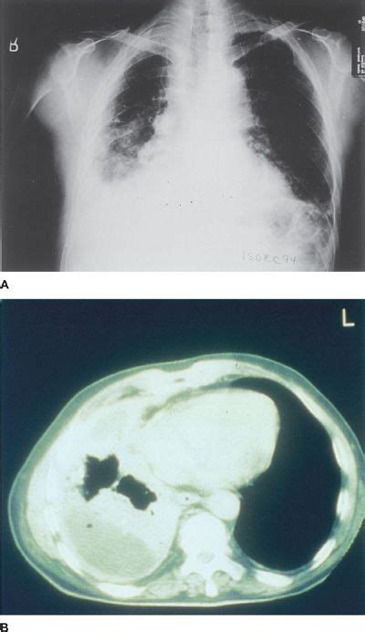 Pleural Tumors