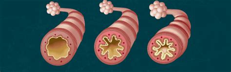 The Copd Gold Stages Explained Lung Institute