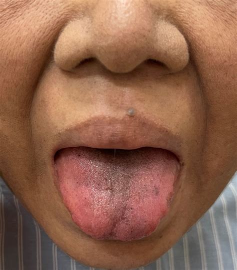 Minocycline Induced Black Hairy Tongue And Skin Hyperpigmentation BMJ