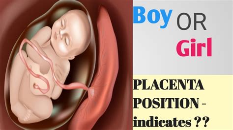 Placenta Position Really Predict The Baby Gender Ii Posterior And