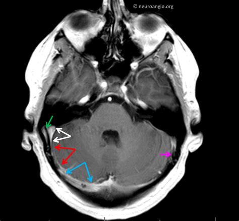 Diagnosis and Treatment of Pulsatile Tinnitus | neuroangio.org