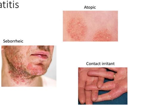 Skin Disorders Eczema Flashcards Quizlet