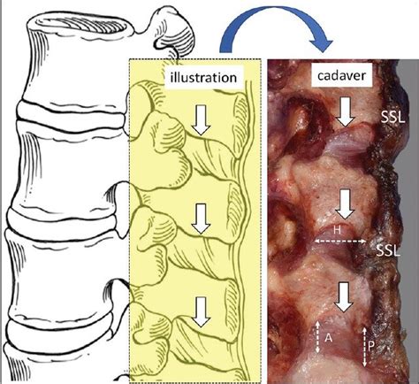 Anatomical And Biomechanical Study Of The Lumbar Interspinous Ligament