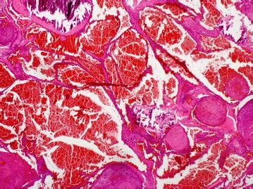 Histology of subcutaneous hemangioma | Download Scientific Diagram