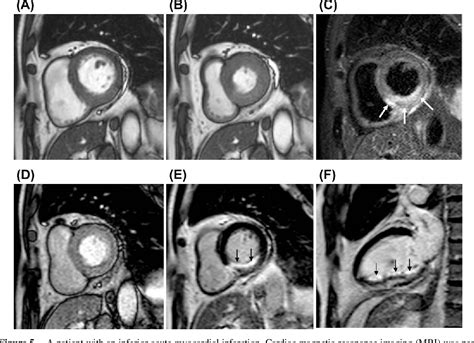 Figure 5 From Cardiac Mri In Ischemic Heart Disease Semantic Scholar