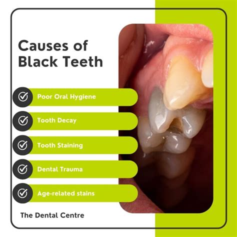 Black Teeth Symptoms Causes And Treatment The Dental Centre