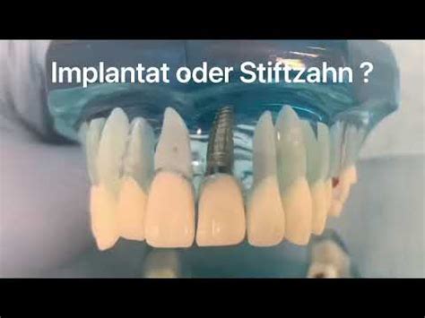 Implantat Oder Stiftzahn Youtube