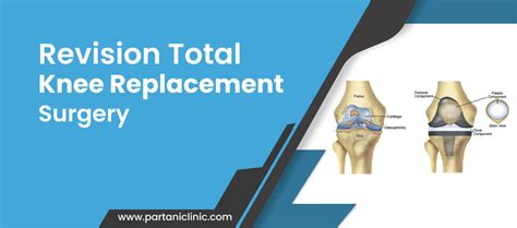 Revision Total Knee Replacement Surgery In Jaipur By Dr Arun Partani