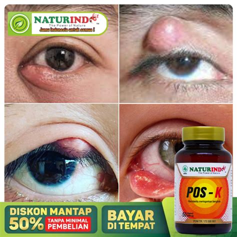 Obat Kalazion Kelopak Mata Obat Benjolan Mata Paling Ampuh Mata