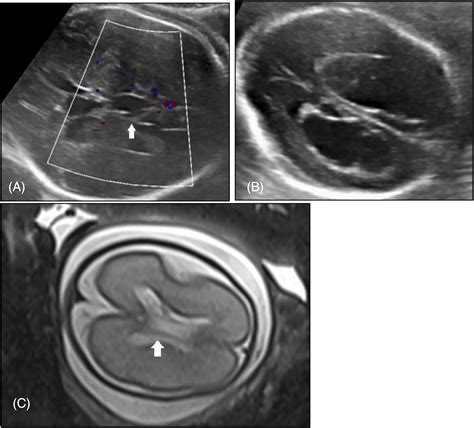 Fetal Porencephaly