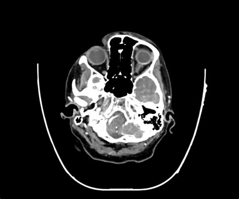 Normal Head Ct Angiogram Image