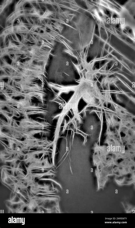 Pulmonary artery, CT scan Stock Photo - Alamy