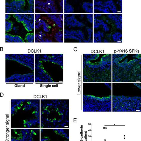 Tuft-like cells are present in human prostate cancer A Tuft cells ...