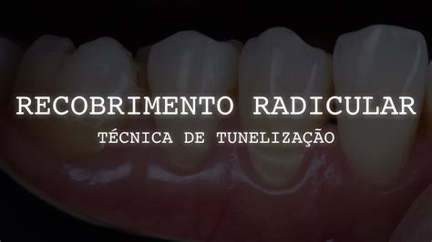 Recobrimento Radicular Sem Retalho T Cnica De Tuneliza O Youtube