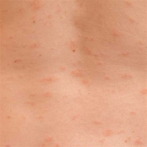 Pityriasis Rosea Most Skincare