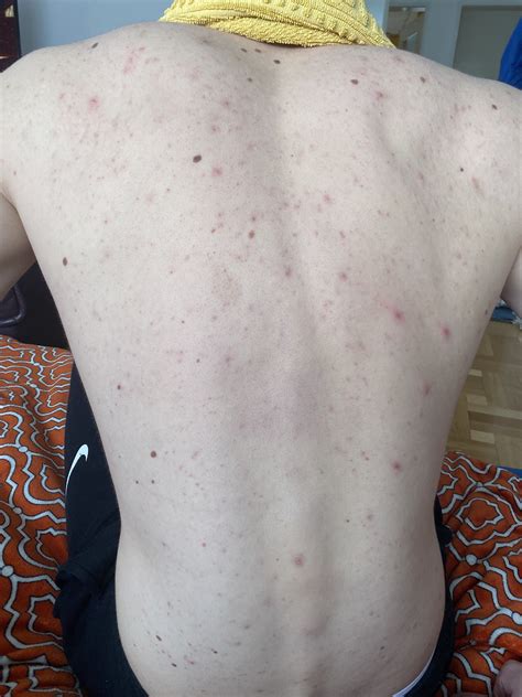 [acne] my boyfriend suffers from bacne, his poor soul is insecure
