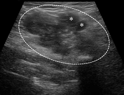 Atypical Sites Of Deeply Infiltrative Endometriosis Clinical Characteristics And Imaging