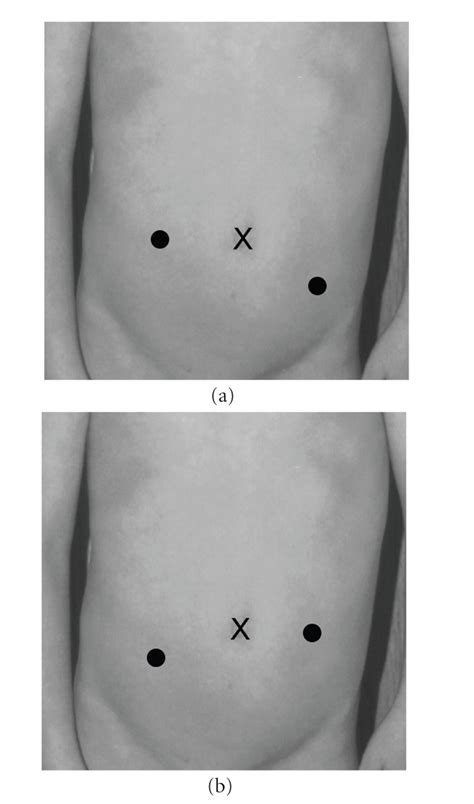 (a) Port placement, right reimplant; (b) port placement, left reimplant ...