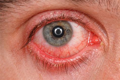 Common Eyes Diseases Their Causes And Possible Remedies Healthtian