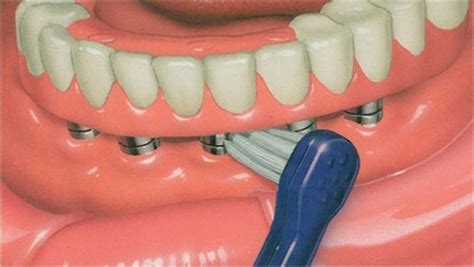 Cleaning A Denture On Implants Dental Pictures Pinterest Cleaning