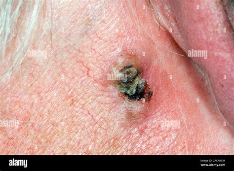 Close Up Of Skin Cancer Basal Cell Carcinoma Behind The Pinna Of The