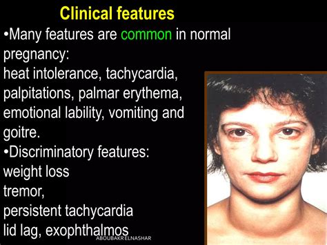 Hyperthyroidism During Pregnancy Ppt