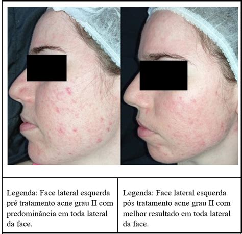 ALTA FREQUÊNCIA NO TRATAMENTO DA ACNE VULGAR ESTUDO EM SÉRIE DE CASOS