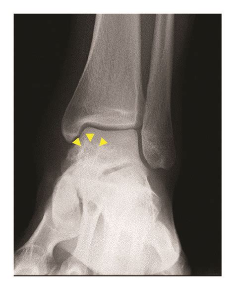 Anteroposterior A And Lateral B Plain Radiographs Of The Left Ankle Download Scientific