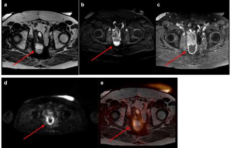 A D Chronic Inflammation With Presacral Fluid Collection A C Axial