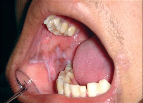 Lichen Planus Mouth Lesions