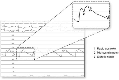 Pulsus bisferiens. Typical hemodynamic waveforms in an unstable patient ...