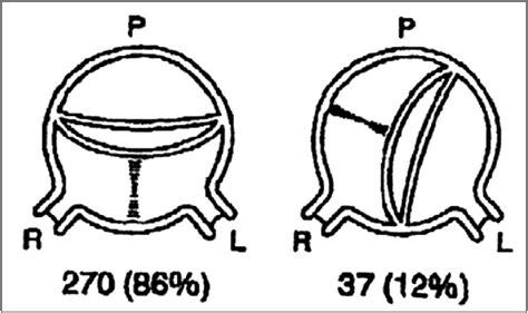 Bicuspid Aortic Valve And Associated Aortopathy An Update Seminars In Thoracic And