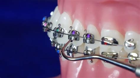 Brackets Met Licos Autoligables Clinica Dental Sonrisa Segura