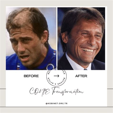 Antonio Conte Hair Transplant: Is It Real?